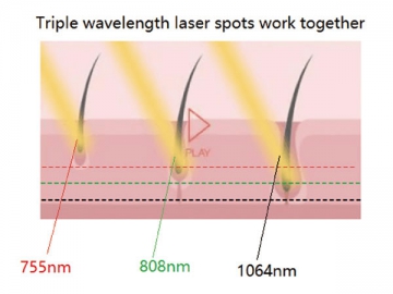 755nm&808nm&1064nm Laser-Enthaarung für 6 Fitzpatrick Hauttypen, FG2000-B
